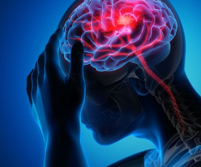stroke risk