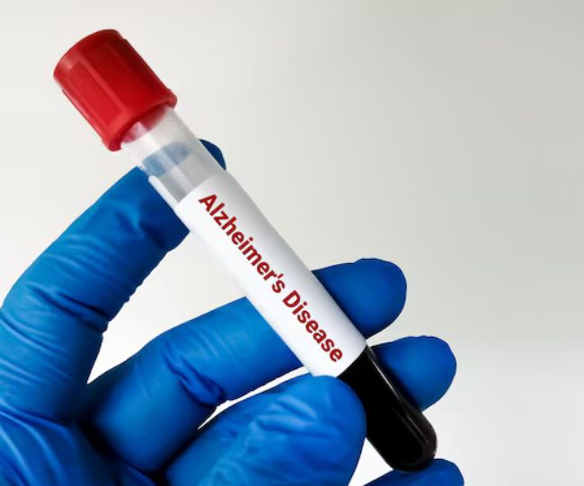 Alzheimer