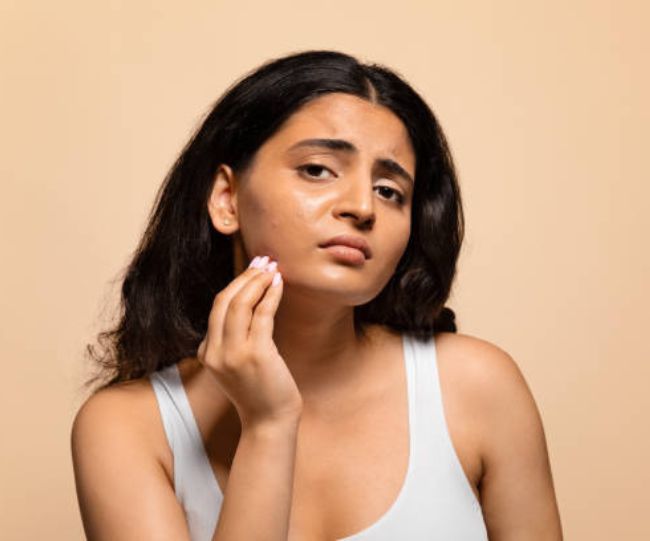 Foods that cause acn