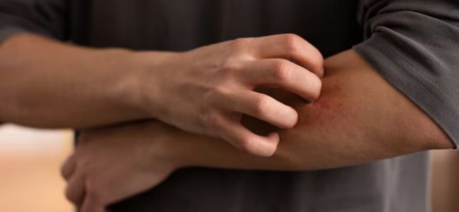 Myths About Dengue and Malaria