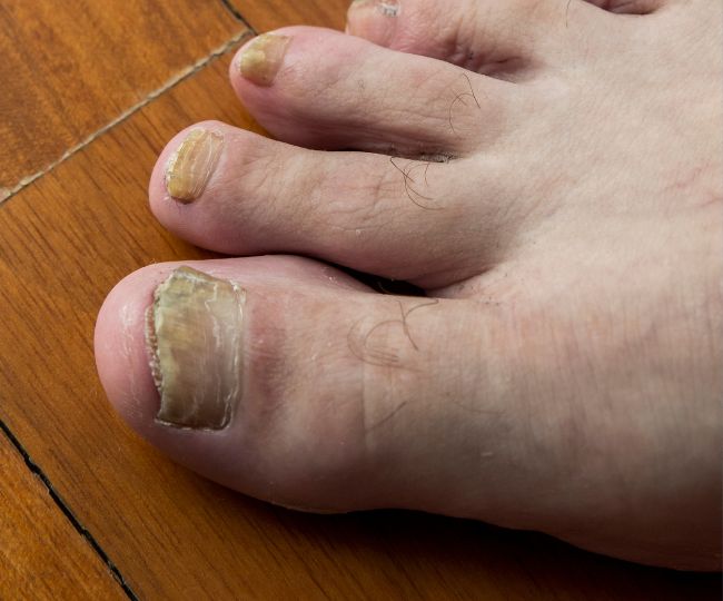 Fungal nail infection