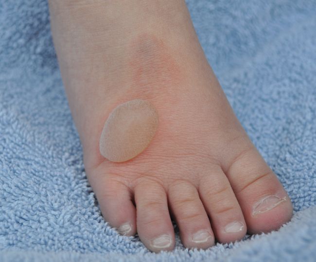 blister