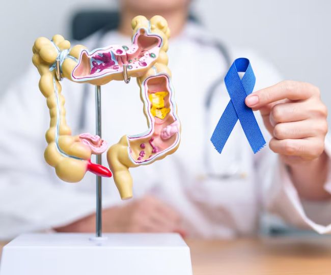 Vitamin D and Colon Cancer