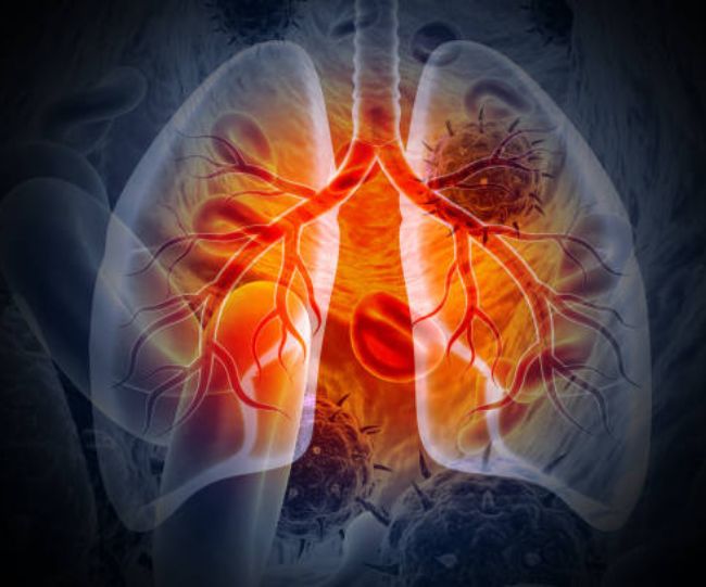 lung cancer risk