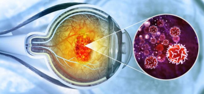 Eye Cancer Symptoms