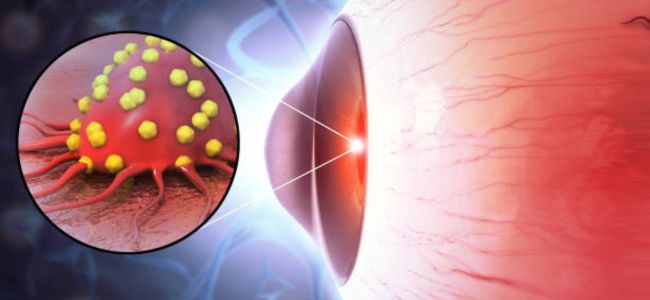 Symptoms of Eye Cancer
