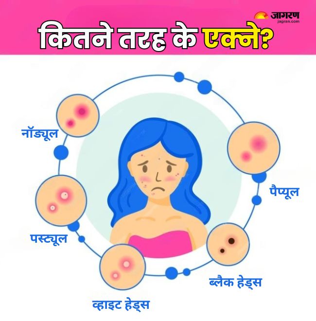 types of acne
