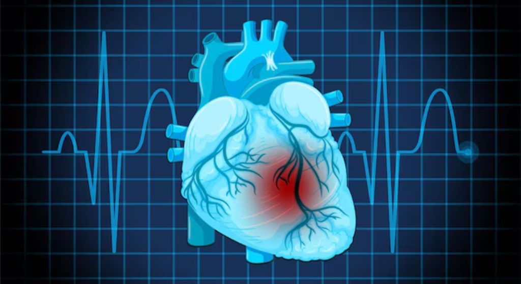 Occlusive Myocardial Infarction