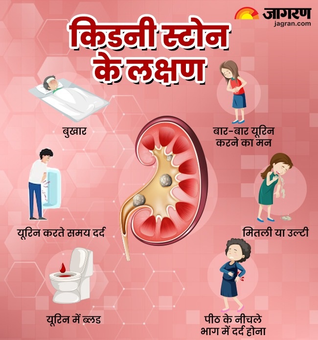 Kidney Stone