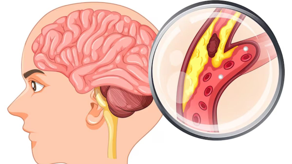 Brain Stroke (1)