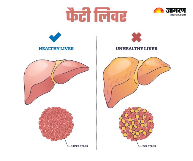 Fatty liver