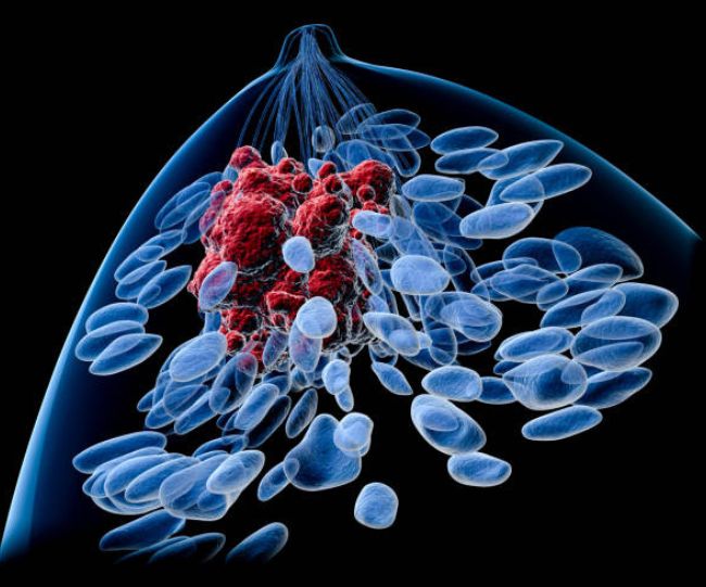 breast cancer