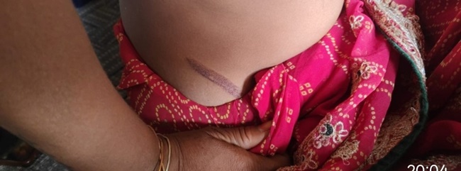 woman burnt 21541