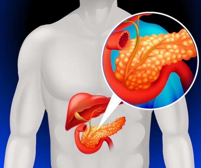 Chronic pancreatitis